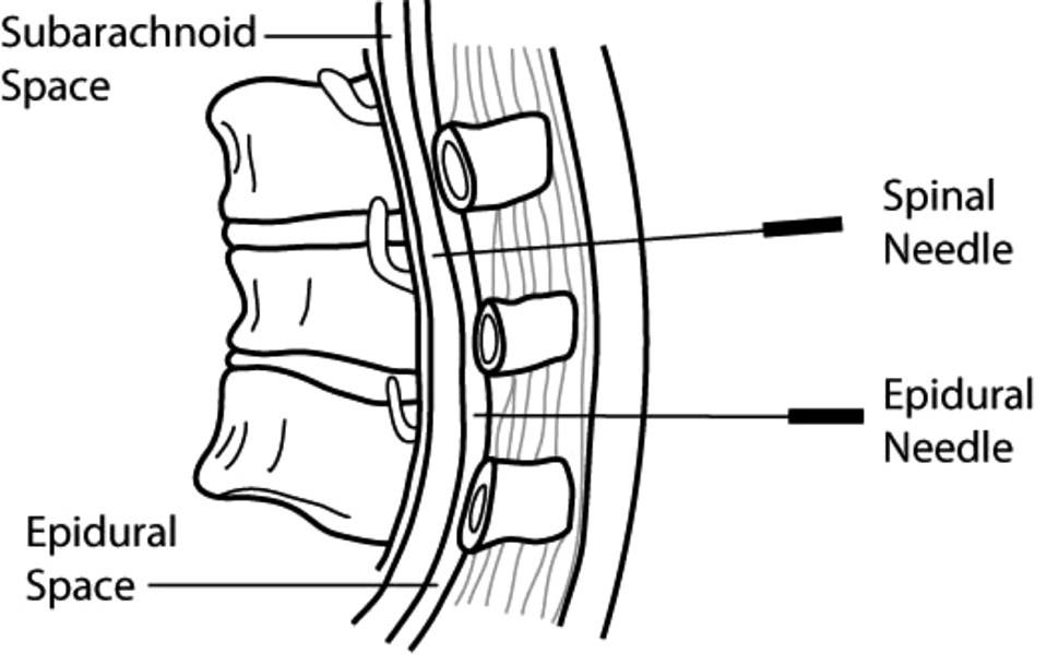 A section of the spine showing the epidural space and epidural needle.