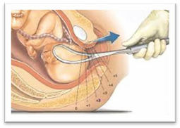 Unborn baby with head held by forceps.
