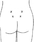 A diagram showing a person’s lower back with four marks showing the locations SWIs are given.