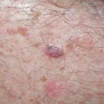 Photo of a basal cell carcinoma (BCC) on skin
