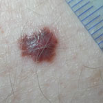 Photo of a melanoma on skin