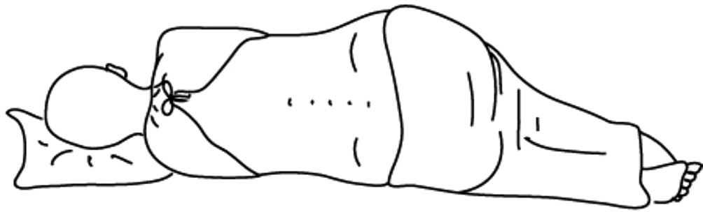 A person lying on their side with knees bent, positioned for an epidural insertion.