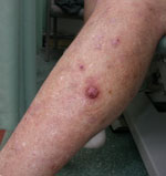 Photo of a squamous cell carcinoma (SCC) on skin
