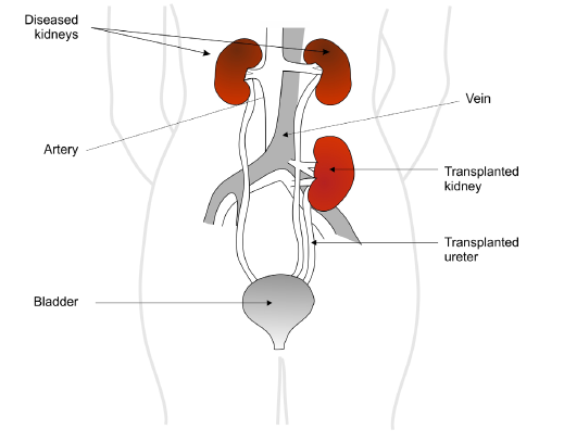 Diagram showing location of a transplanted kidney