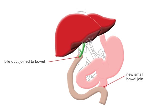 Diagram of Roux-en-Y liver transplant