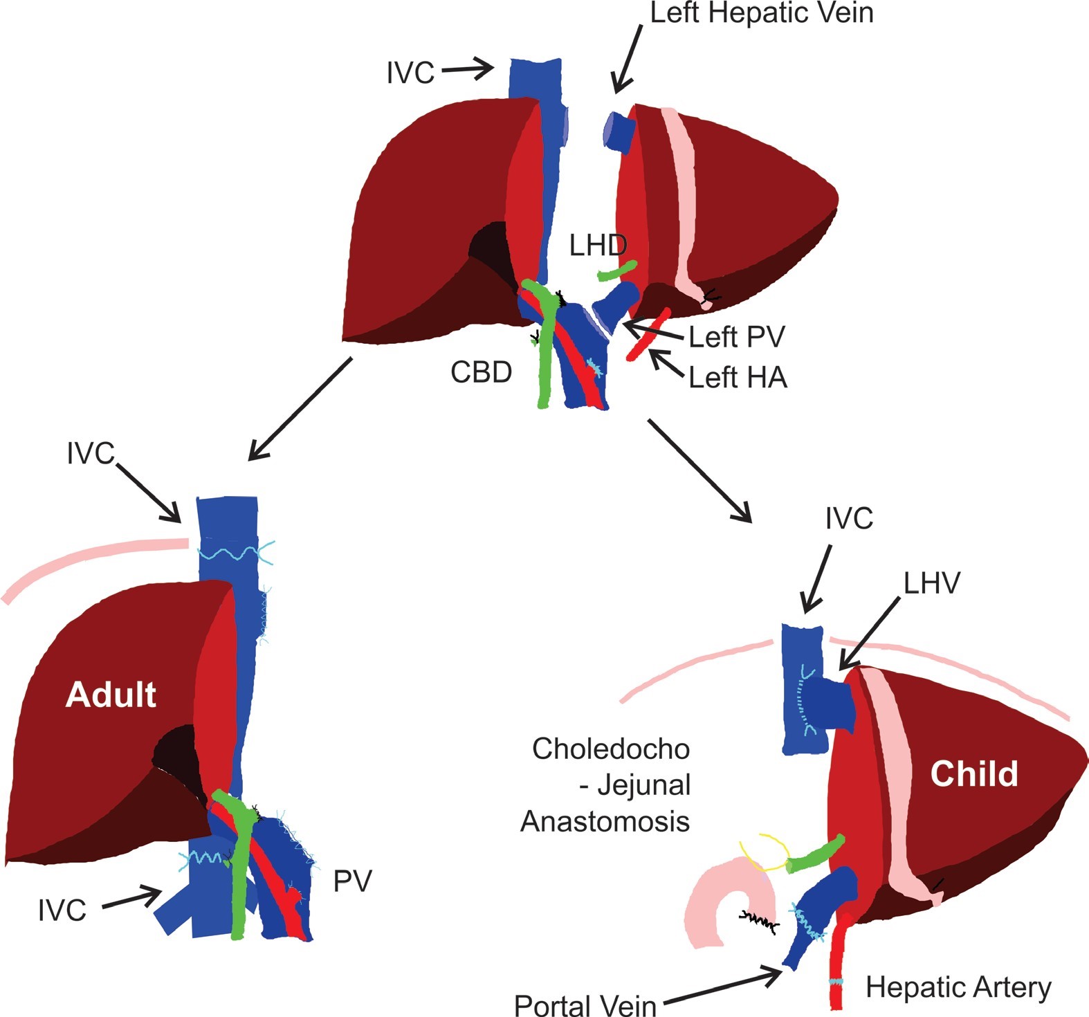Diagram of “Split” Liver Transplantation