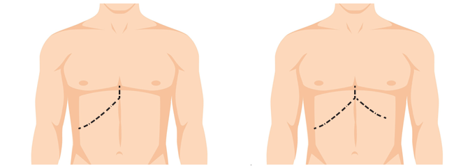Diagram of liver transplant incisions